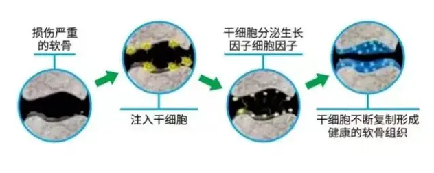 干细胞治疗膝骨关节炎已成全球趋势 3.png